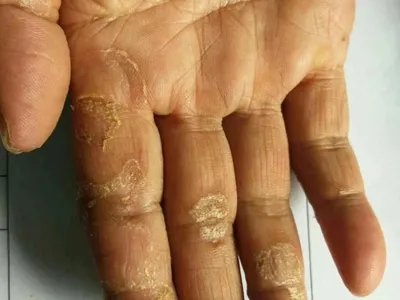 手部湿疹手指皮肤粗糙图片