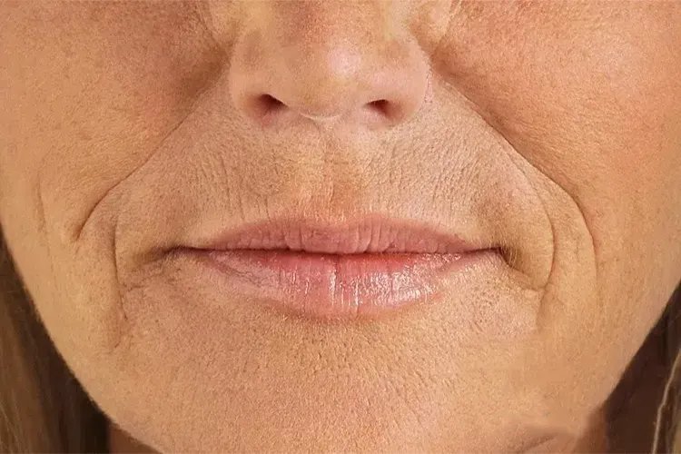 笑纹和法令纹的区别图