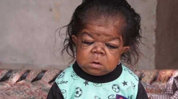 我国约有2000万罕见病患者，这些罕见的疾病有哪些？