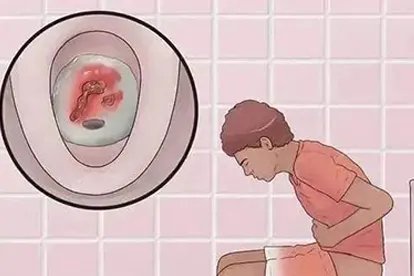 肛门正常图与痔疮图片