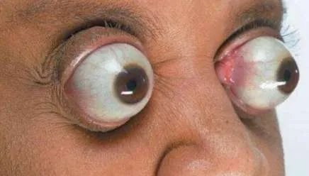 世界上眼球最突出的人——约翰·道尔(12毫米)