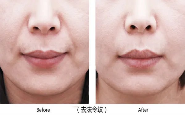 减少法令纹的方法