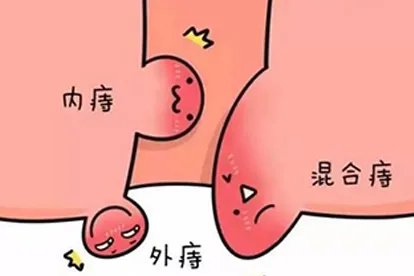 肛门正常图与痔疮图片
