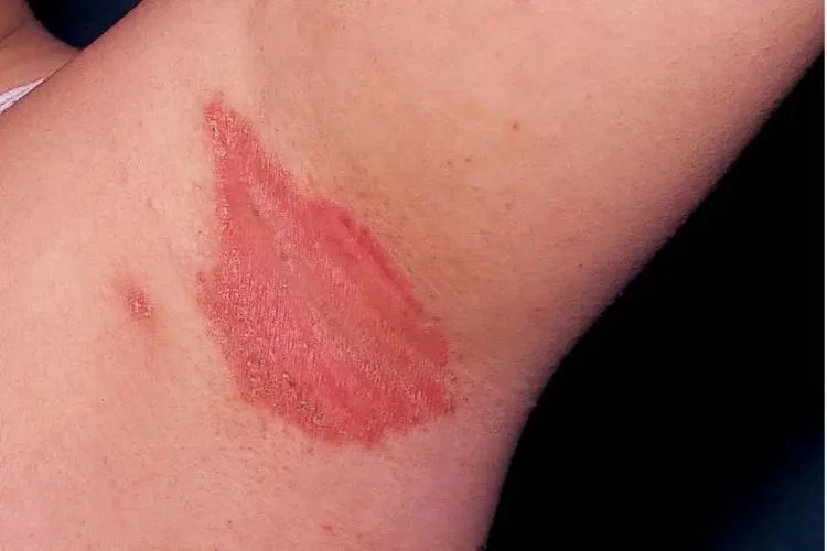 女生腋下皮肤病图片大全