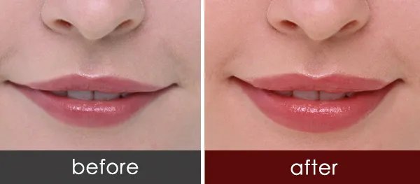 玻尿酸丰唇手术大概需要多少钱