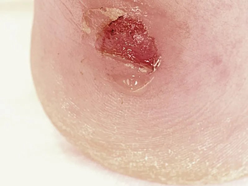 水泡型脚气的症状