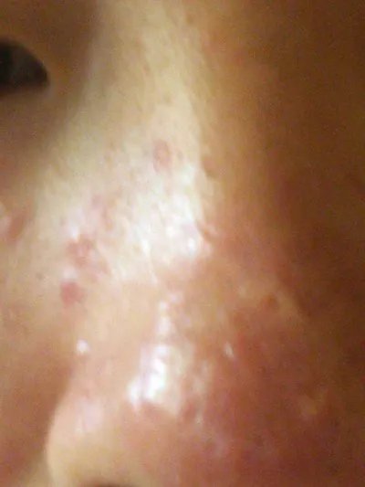 激光去青春痘好吗？