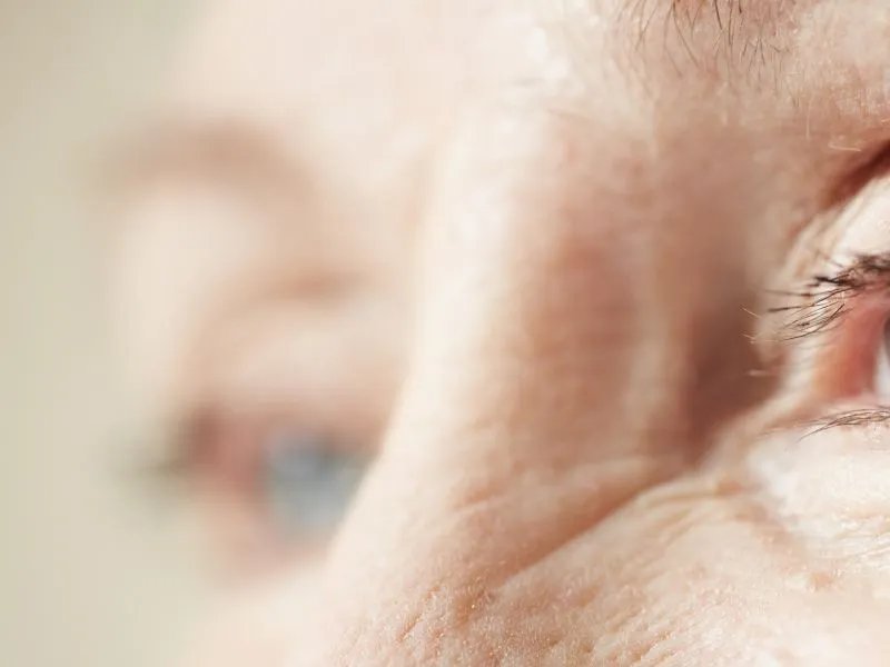 如何去除眼角的细纹