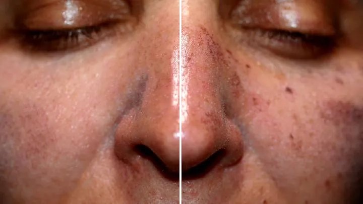 嘴角起增殖性痤疮怎样治疗