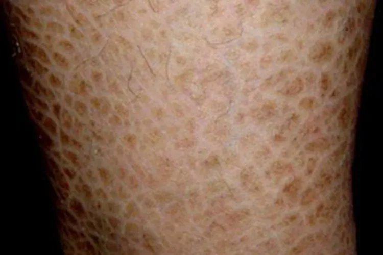 寻常型鱼鳞病小腿症状图片