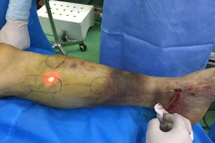 静脉曲张怎么治疗最好的方法腿部图片