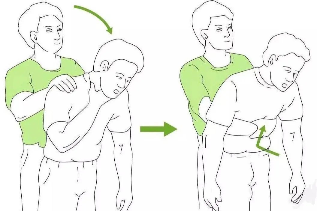 海姆立克急救法三步骤图解