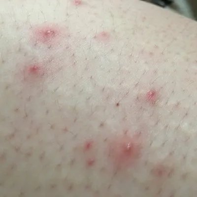 激光去青春痘好吗？