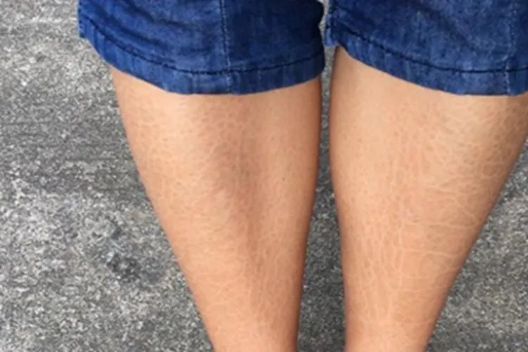 寻常型鱼鳞病小腿症状图片