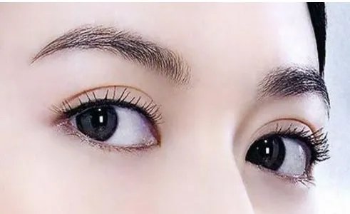 眼部抽脂多少费用