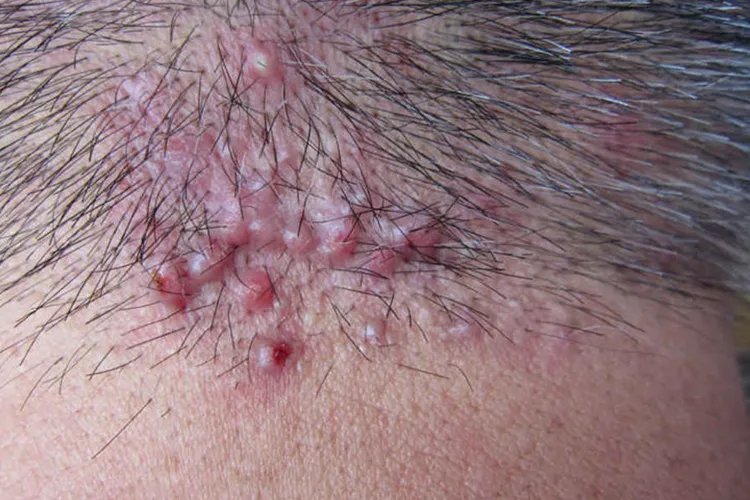 毛囊炎变成硬疙瘩图片