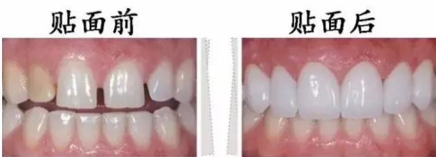 齿白金洗牙粉有害吗