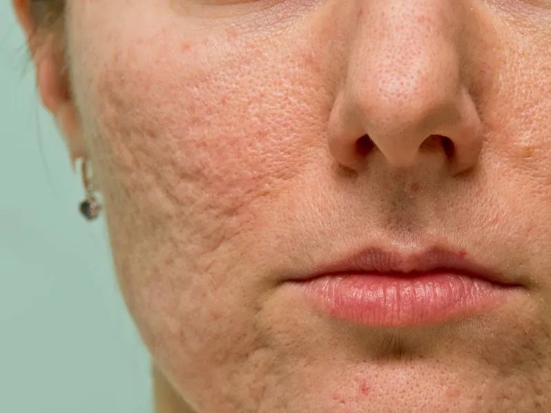 皮肤暗黄粗糙怎么办