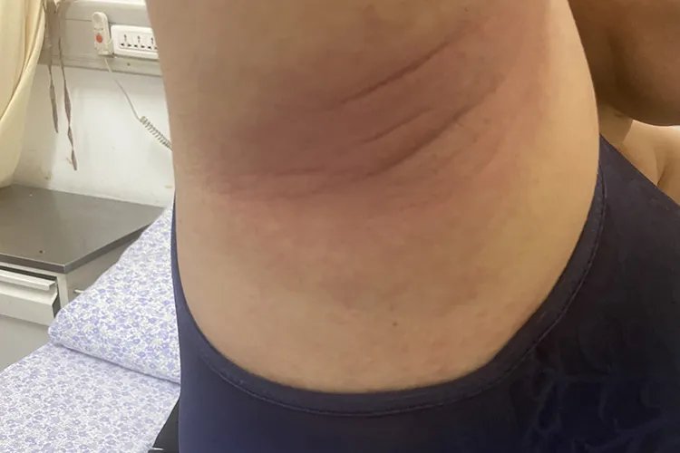 女生腋下皮肤病图片大全