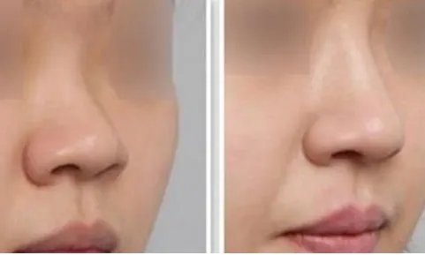 缩小鼻翼前后对比照