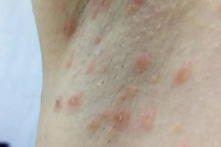 女生腋下皮肤病图片大全