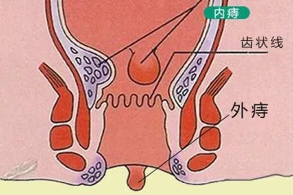 肛门正常图与痔疮图片