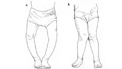 罗圈腿穿什么样的裤子