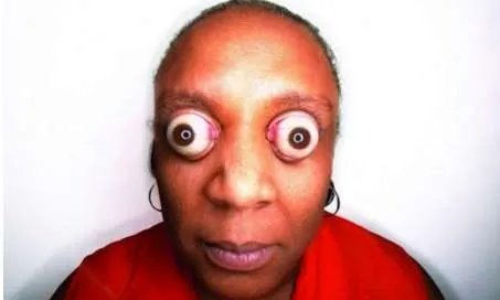 世界上眼球最突出的人——约翰·道尔(12毫米)