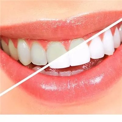 四环素牙如何美白