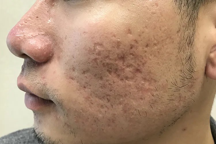 脸上长痘痘的原因图解