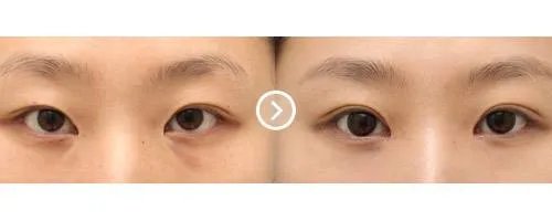 做开眼角手术效果好不好呢？
