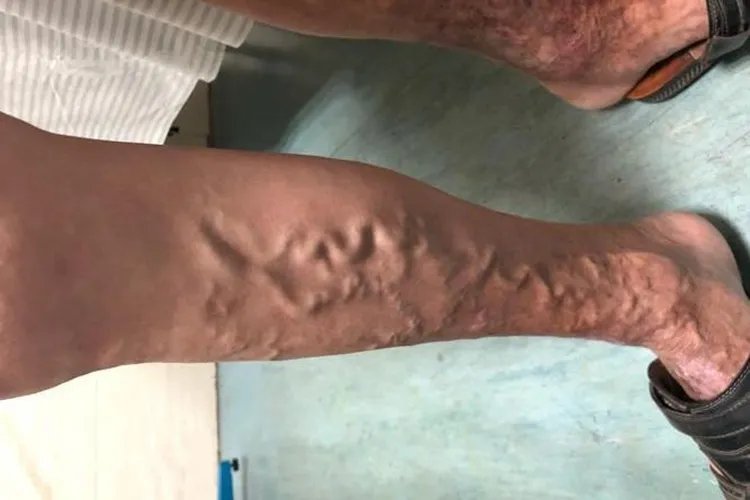 静脉曲张怎么治疗最好的方法腿部图片