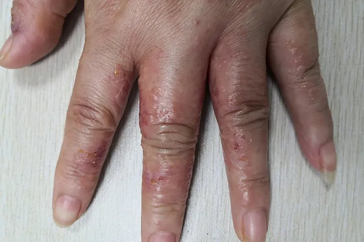 过敏是什么样子的图片